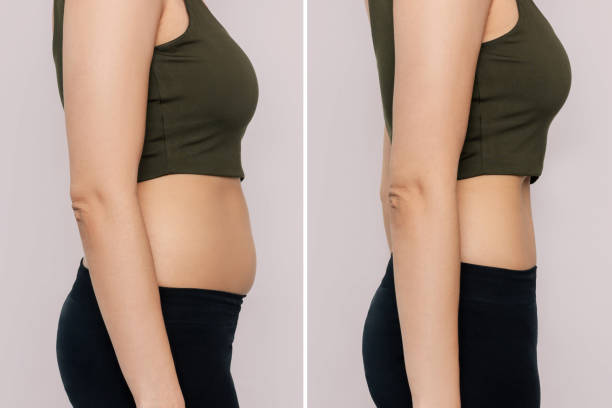 Are You a Suitable Candidate for Liposuction?