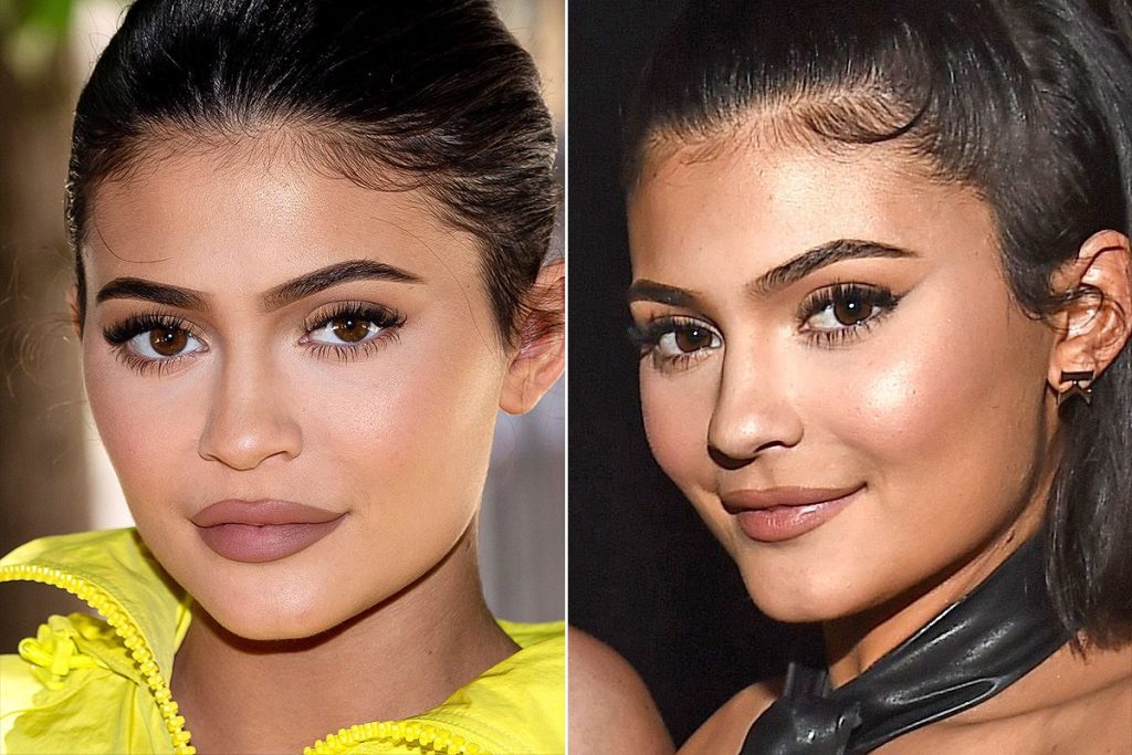 Why Kylie Jenner is a Fan of Lip Injections